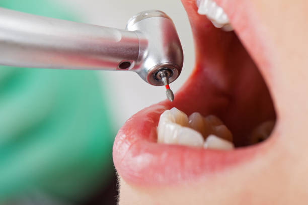 Best Emergency Tooth Extraction in Four Corners, MD
